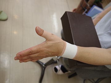 手関節捻挫の治療法