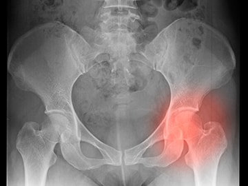 股関節手術後の痛み